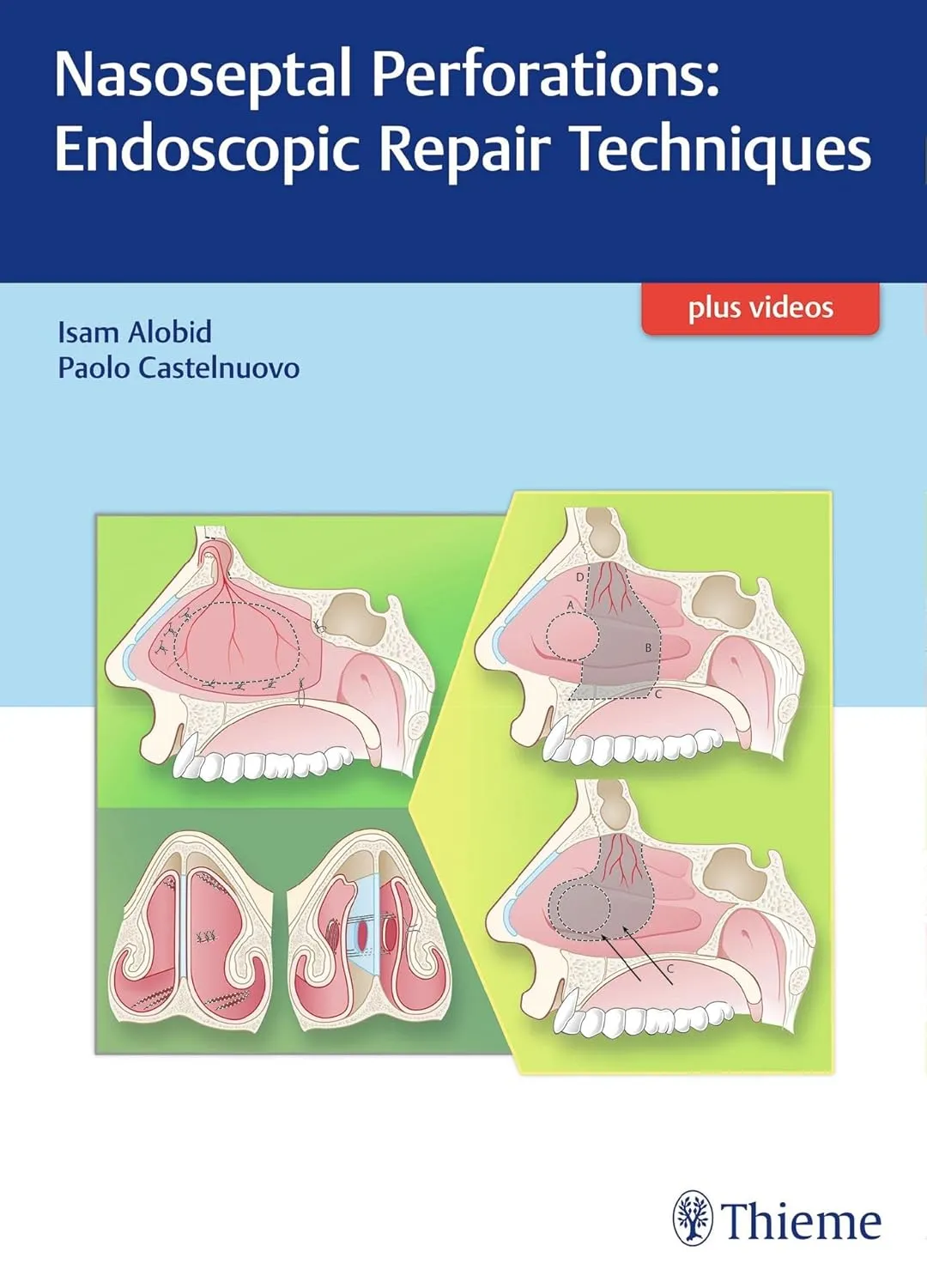 Nasoseptal Perforations: Endoscopic Repair Techniques 1st Edition