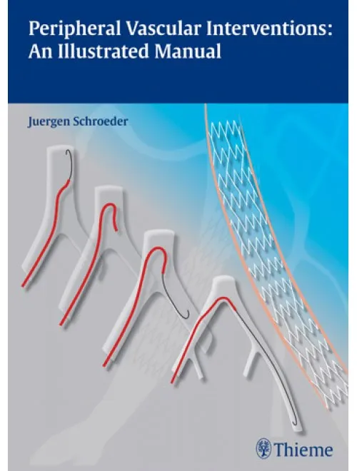 Peripheral Vascular Interventions An Illustrated M - 1st edition