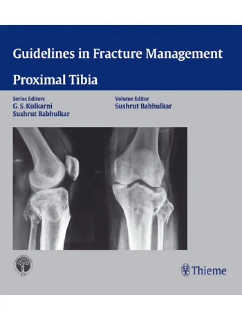 Proximal Tibia - 1st Edition