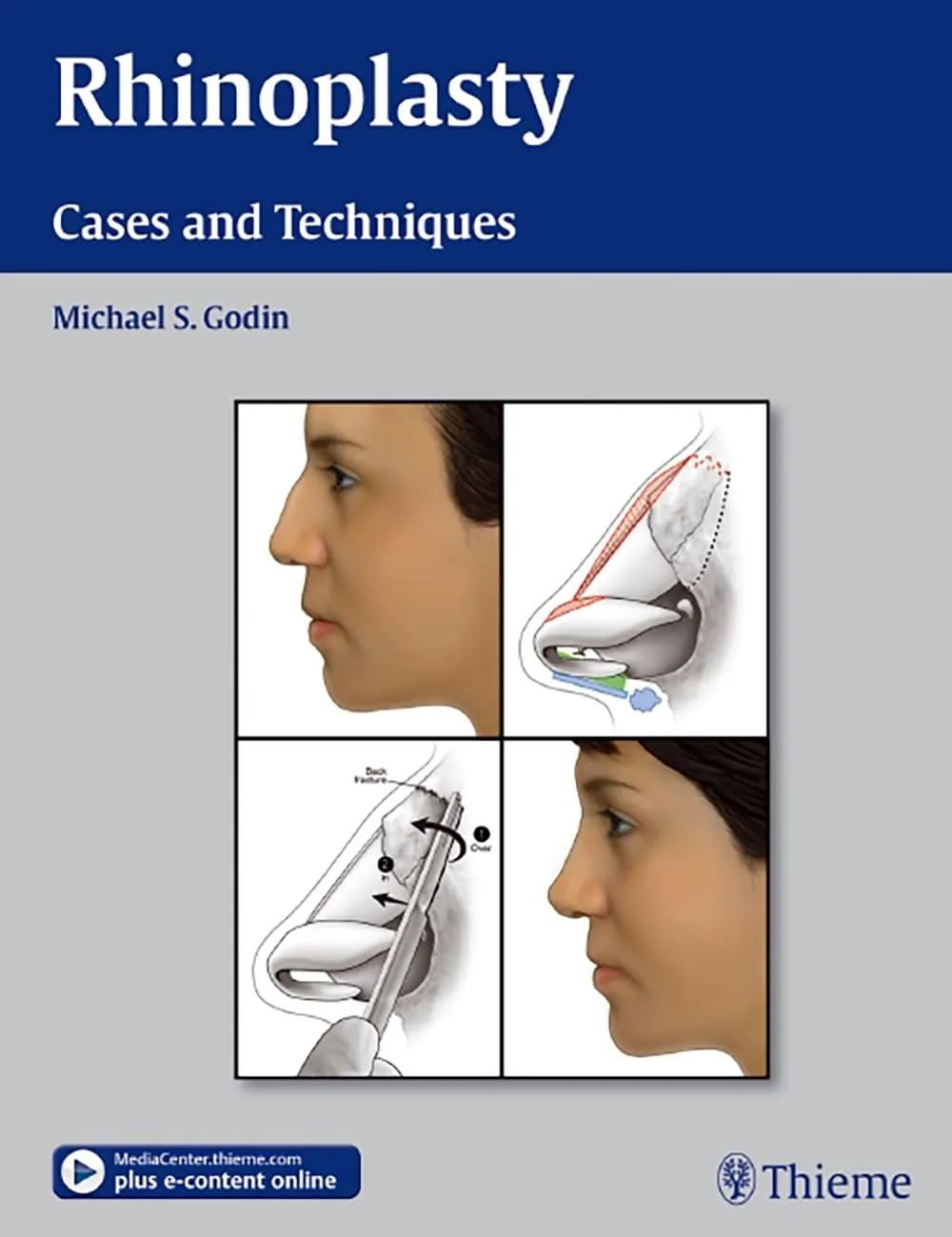 Rhinoplasty Cases and Techniques | 1st Edition