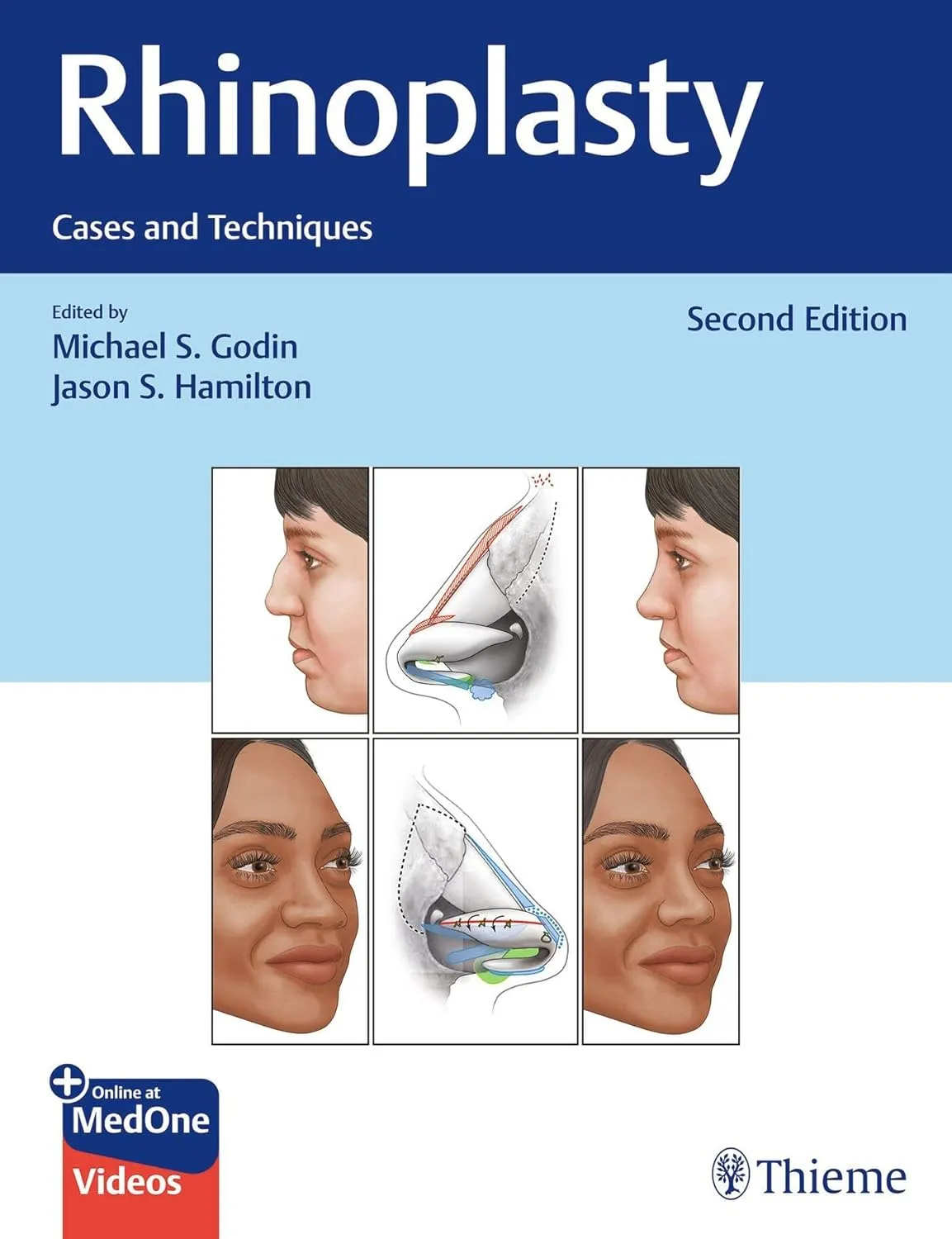 Rhinoplasty Cases and Techniques | 2nd Edition