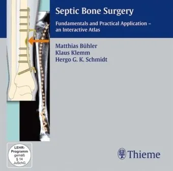 Septic Bone Surgery CD-ROM - 1st Edition