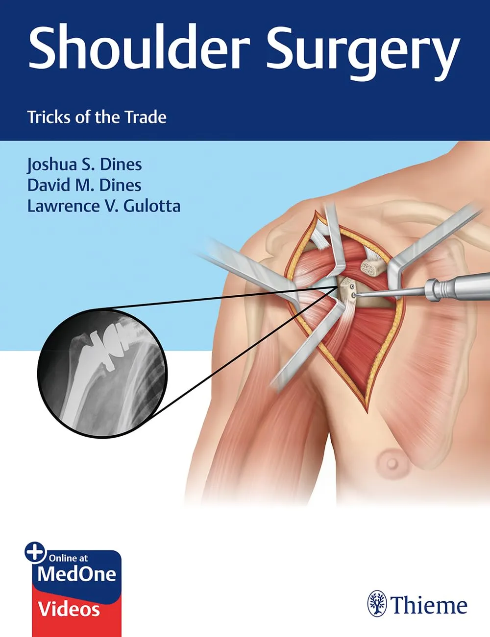 Shoulder Surgery Tricks of the Trade 1st Ed.