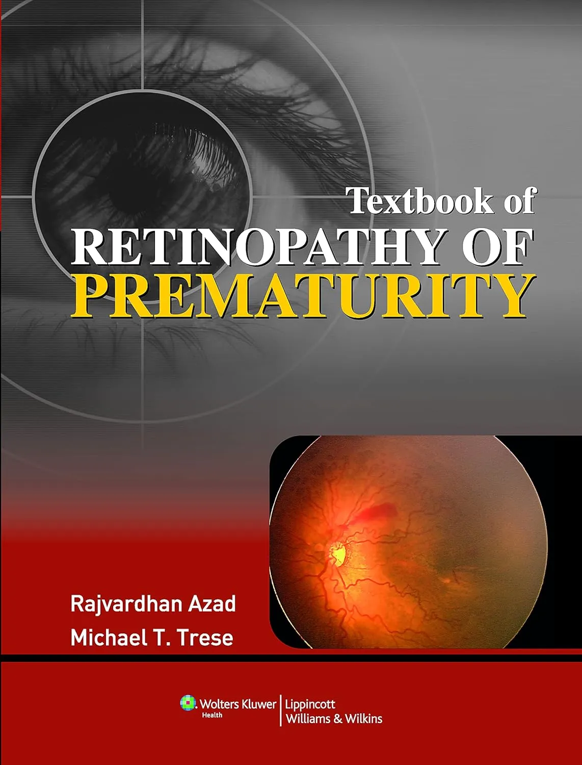 T.B of Retinopathy of Prematurity