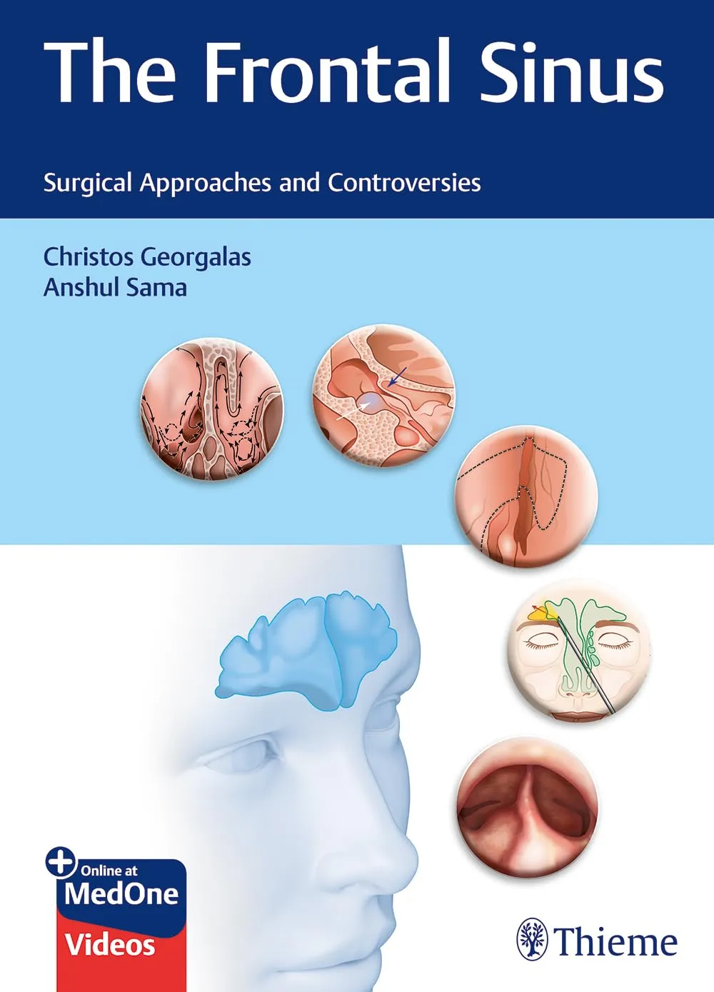 The Frontal Sinus : Surgical Approaches and Controversies 1st Ed.