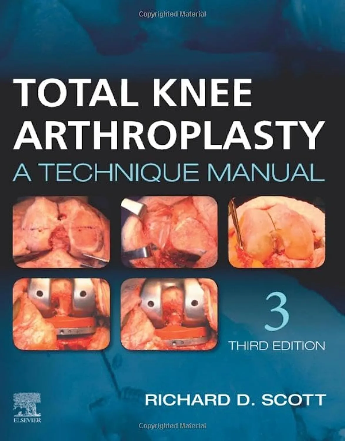 Total Knee Arthroplasty - 3E