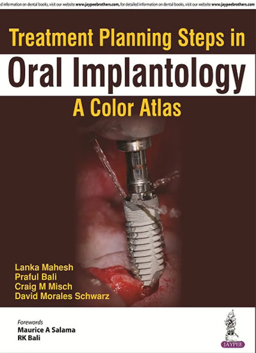 Treatment Planning Steps in Oral Implantology | A Color Atlas